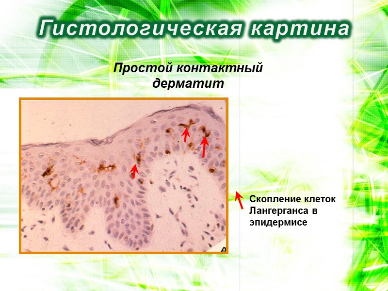 Гистологическая картина Простой контактный дерматит Скопление клеток Лангерганса в эпидермисе